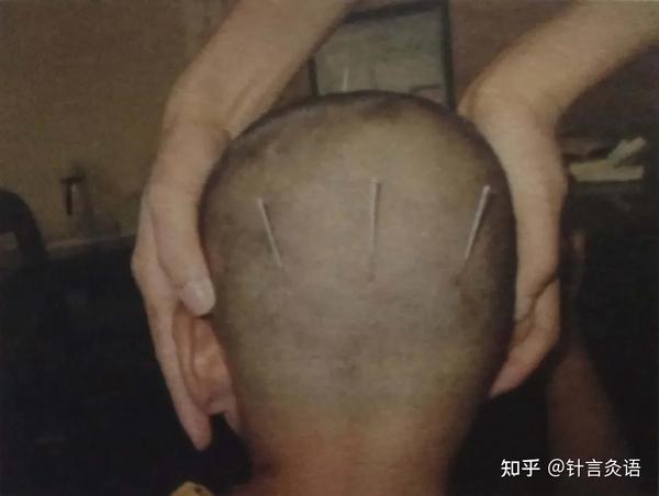 中风系列│靳三针中风针法