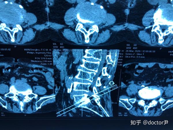 腰部ct,l5/s1定位图,第5腰椎与骶骨之间明显存在滑脱
