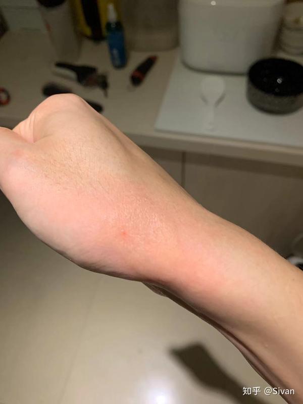 记录蒸汽烫伤恢复过程