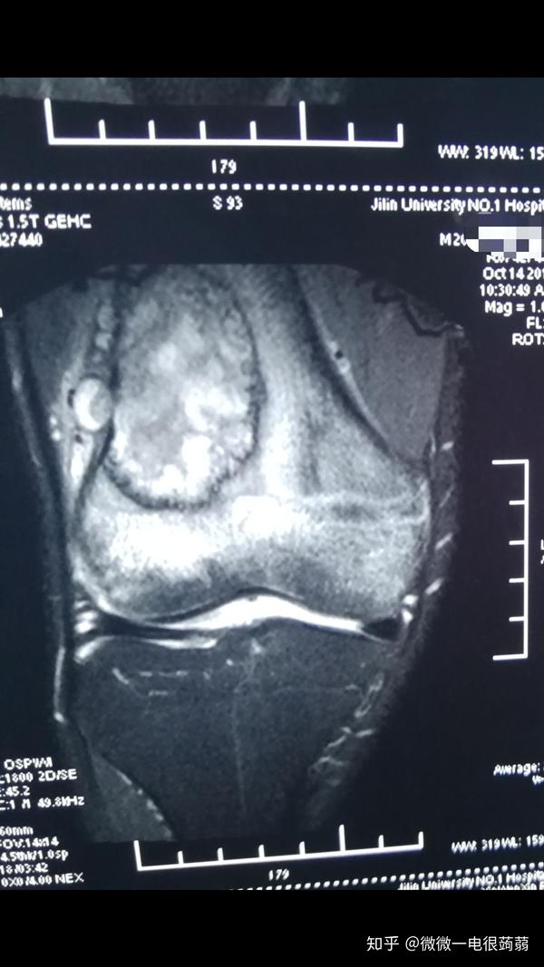 拍了核磁,显示股骨远端有一个囊状的肿瘤.