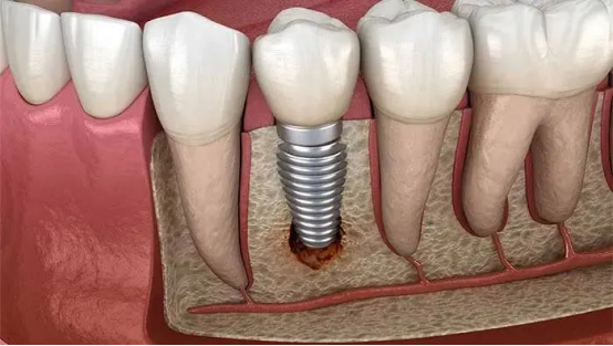 种植牙是牙齿修复最好的一种方法