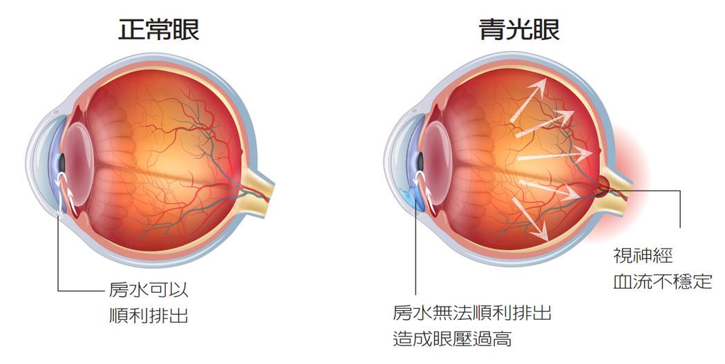 青光眼真的可以靠药水治愈别被骗了做好这三点比药水管用