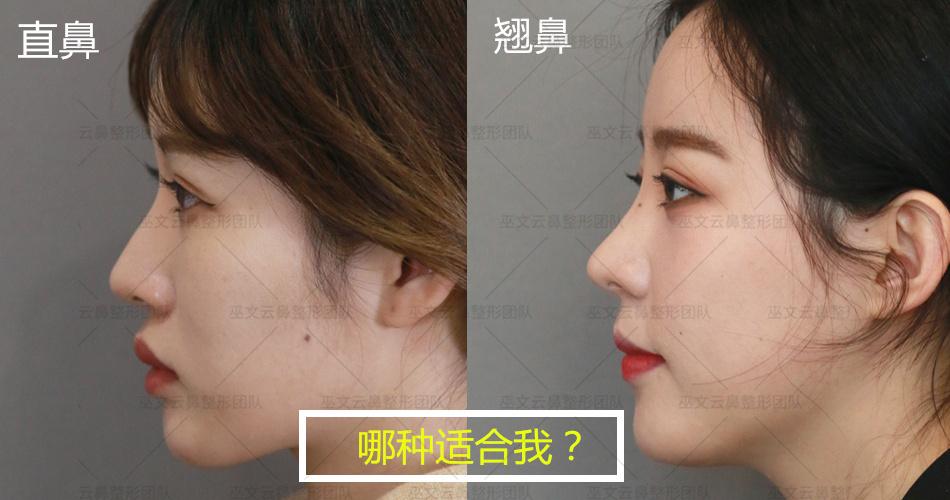 隆鼻,要直鼻还是翘鼻?你知道如何选吗?