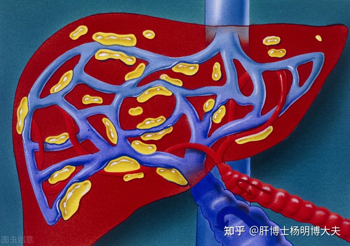 警惕肝硬化患者出血