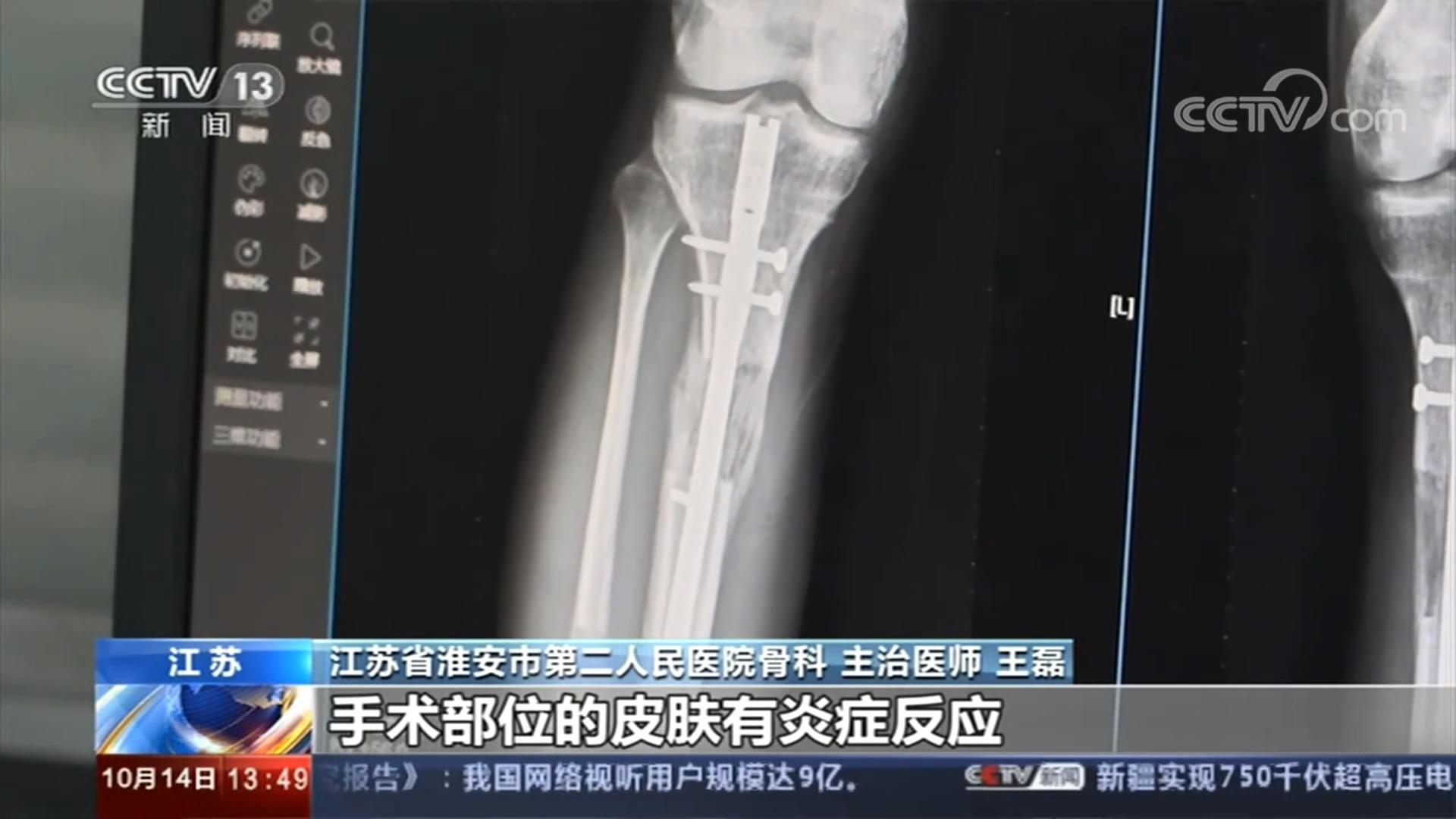 小伙断骨增高失败终身残疾:身高不足1米8自卑