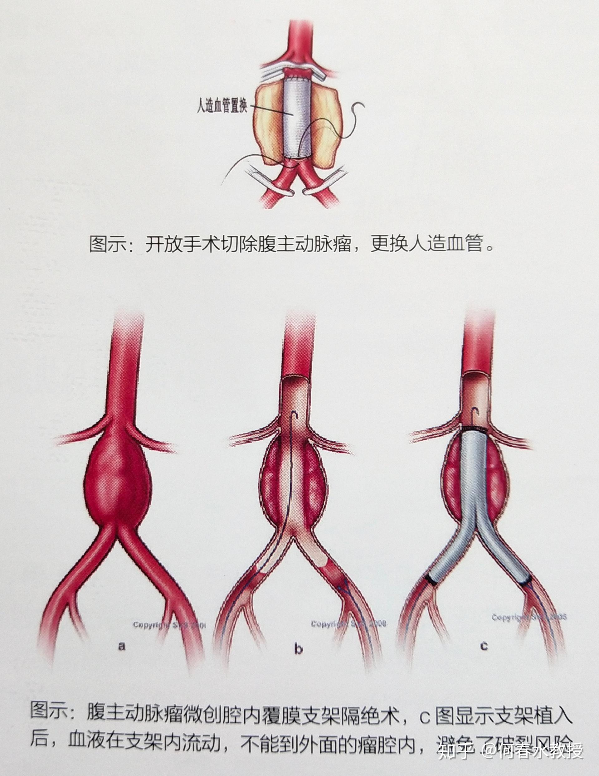 沉默的杀手腹主动脉瘤