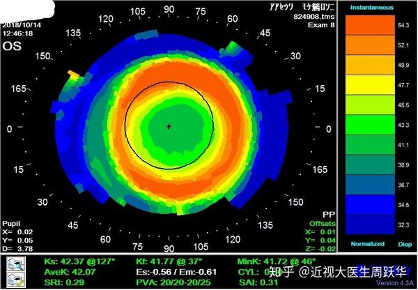 佩戴角膜塑形镜后(角膜地形图检查结果)