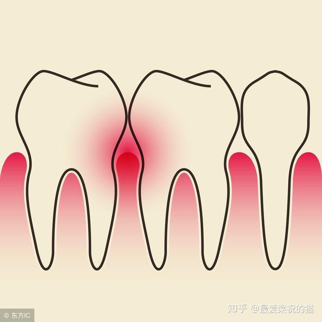 食物残渣堆积在牙齿内部,刺激牙龈,导致牙龈乳头炎症性退缩,慢慢地