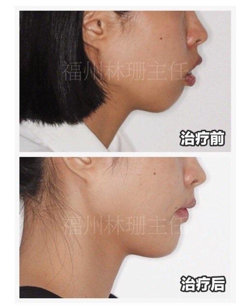 福州牙齿矫正-林珊谈正畸-聊一聊下颌后缩
