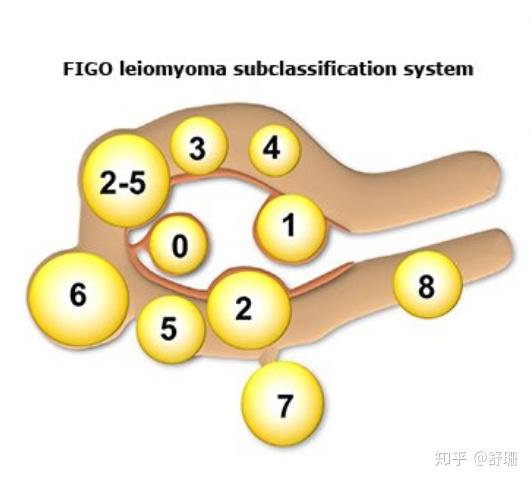 子宫肌瘤的分类
