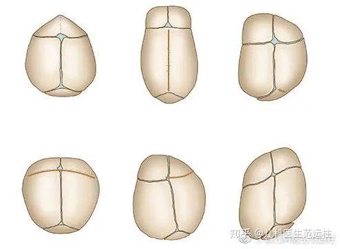 如下面的新生儿囟门颅缝图(图 1,当囟门,颅缝未长合期间,由于不同