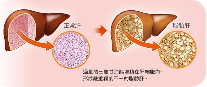 脂肪肝患者应遵循的饮食是什么?