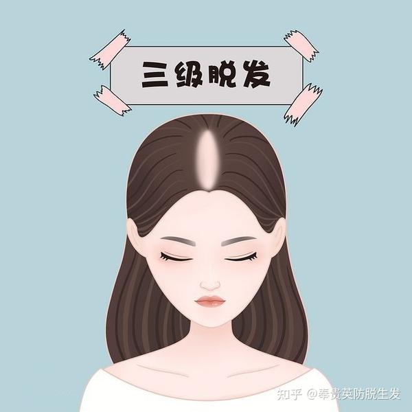 四级脱发:分发处明显看到头皮周边稀少范围扩大.