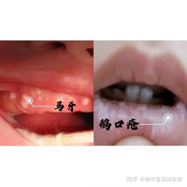 马牙是乳牙的牙胚发育的过