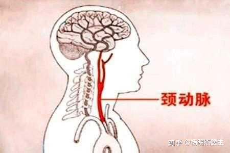 吸烟对颈动脉硬化形成影响最大