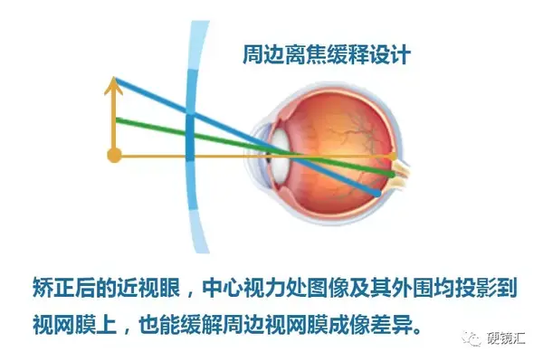 孩子度数太高散光太大角膜曲率太平家长该选择哪种有效的近视防控手段