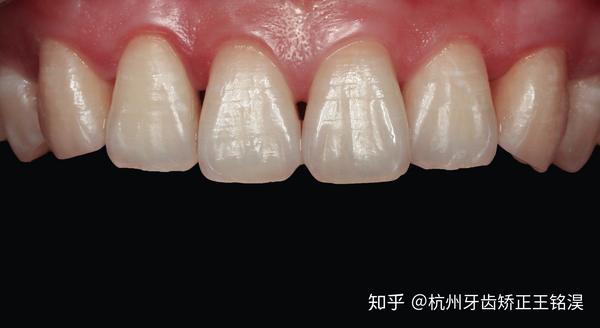 王医生正畸科普片切邻面去釉技术