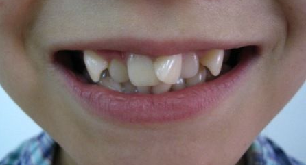 牙齿畸形的原因是什么 日常有哪些矫正的方法