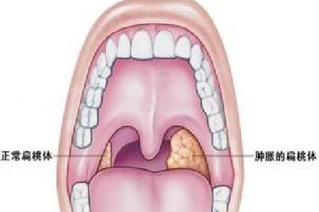 都是扁桃体,只不过腭扁桃体位于口咽外侧壁在腭咽弓和