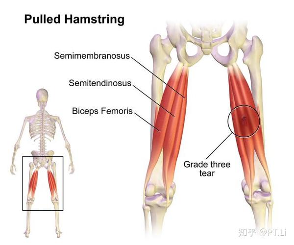 腘绳肌拉伤与预防 (hamstring strain)