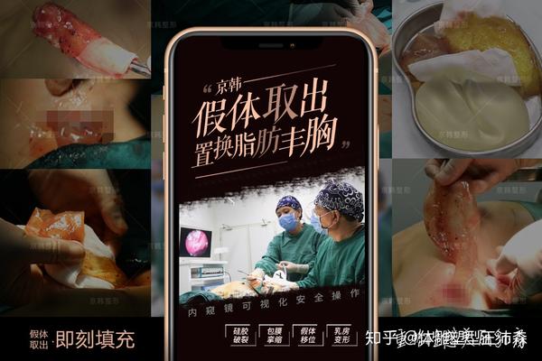 隆胸假体取出后可以直接做自体脂肪丰胸吗