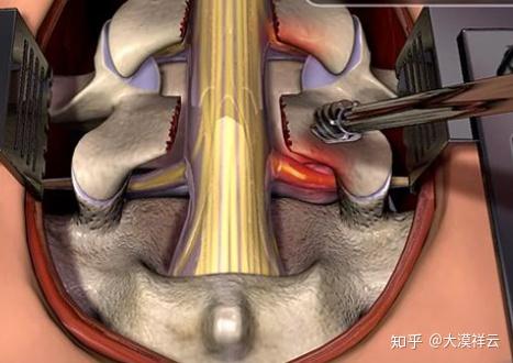 腰椎间盘突出压迫坐骨神经痛怎么治疗.腰椎间盘突出者