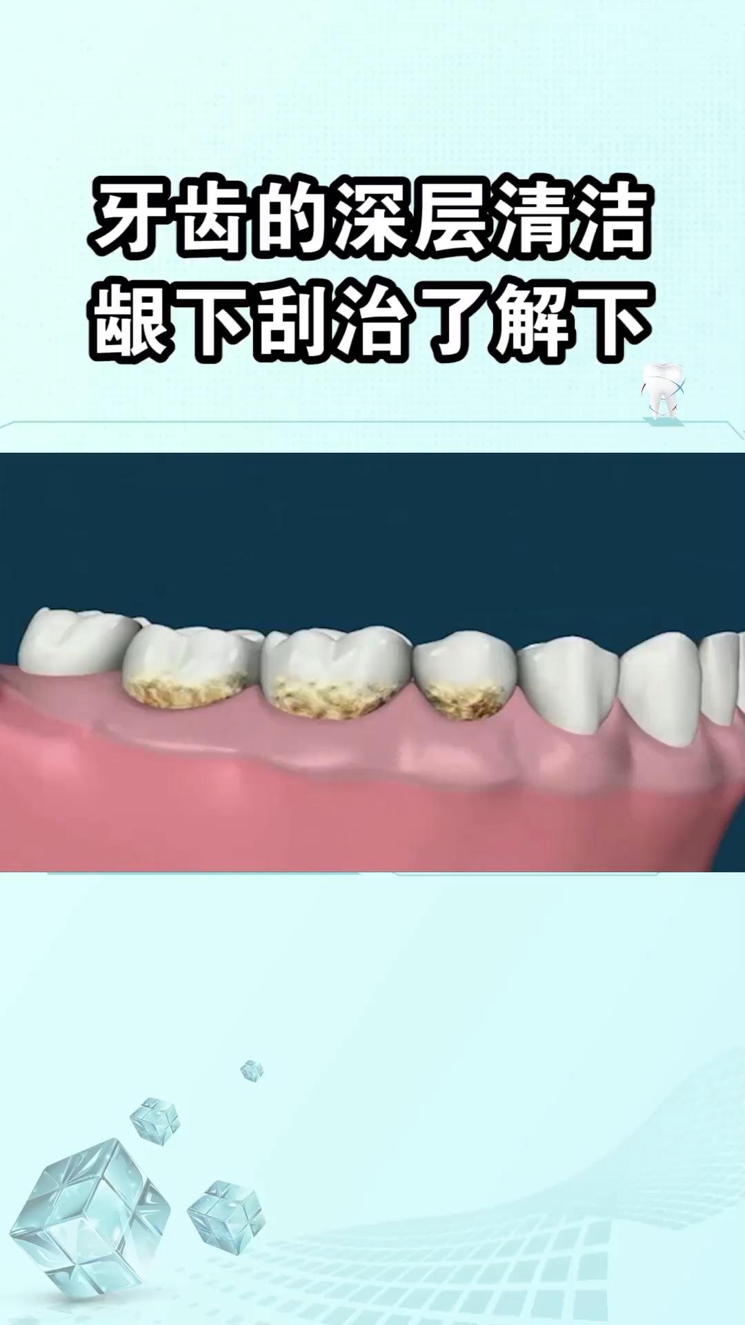 44 · 6 次播放健康牙齿正畸牙齿牙科口腔健康相关推荐 0:22牙齿上下