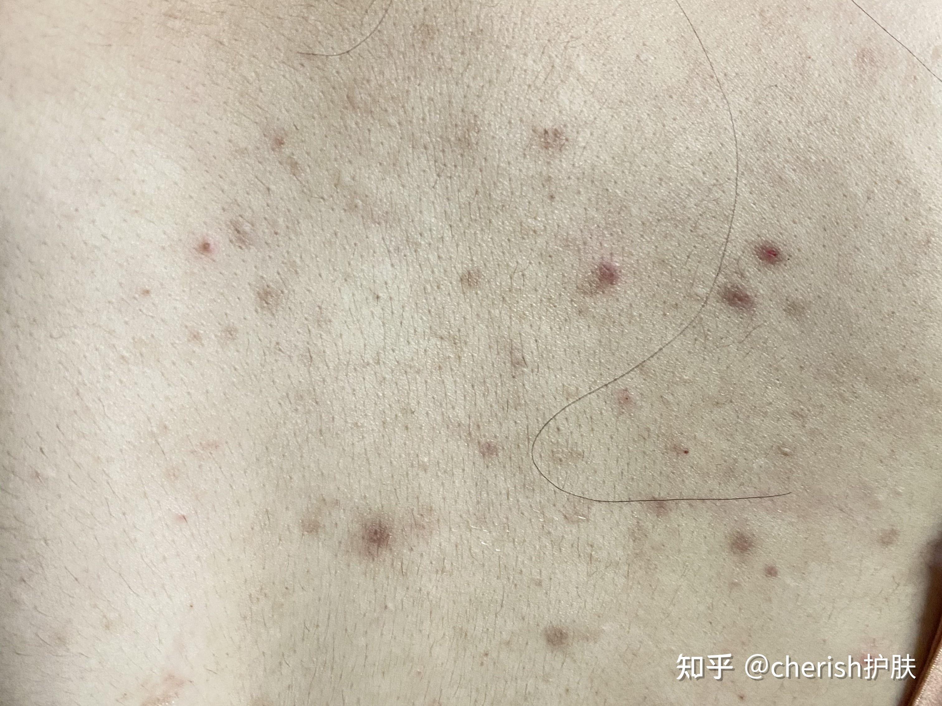 后背毛囊炎毛孔密密麻麻黑点该怎么办