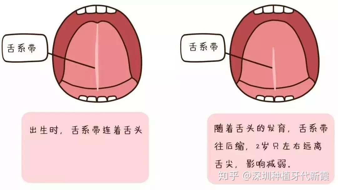 什么是舌系带短这会有什么影响吗该怎么判断舌系带短孩子舌系带过短