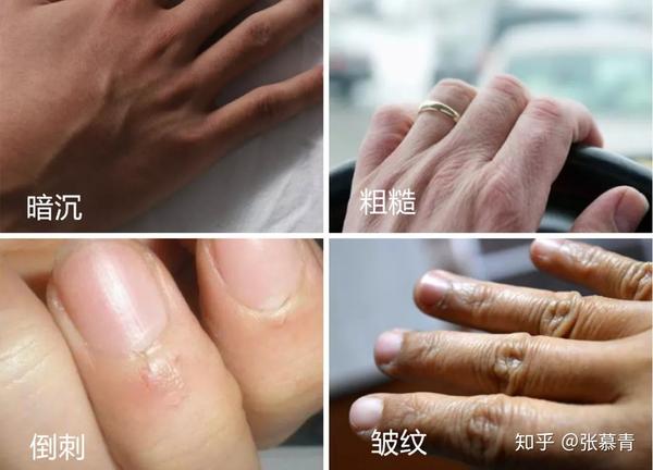 那么如何才能告别干枯如树皮的"主妇手"?