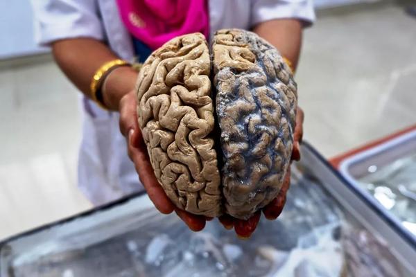 一颗由福尔马林固定的人类大脑,研究人员正准备将它递给参观者.