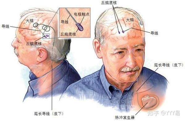 脑起搏器治疗帕金森病示意图