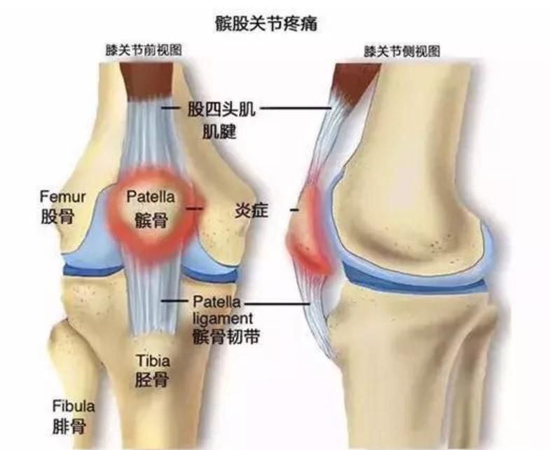 不可忽视的膝关节疾病髌骨脱位