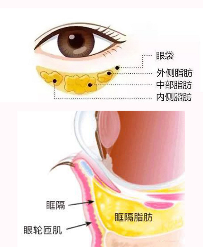 眶隔脂肪释放术是一种祛除眼袋的一种手术方式