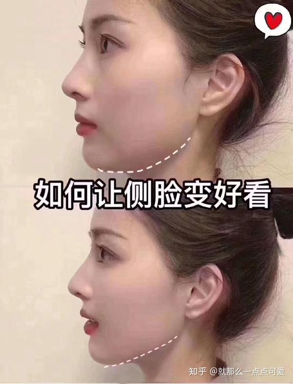 造成下颌缘轮廓不清晰,侧面不好看的原因有面部脂肪堆积,颈阔肌松弛