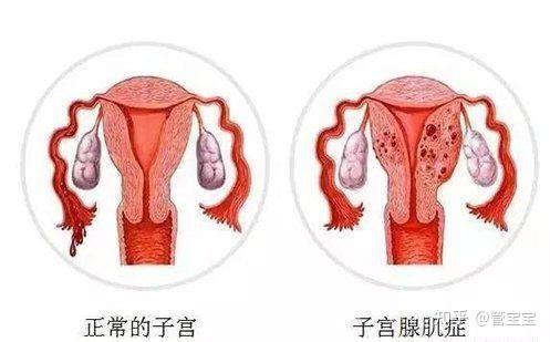 得了子宫腺肌症就没机会怀孕了