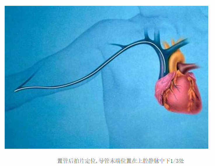临床08picc术经外周静脉置入中心静脉导管术