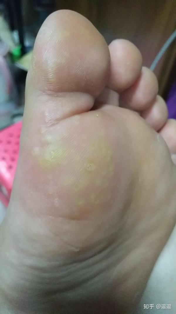 跖疣怎么治?