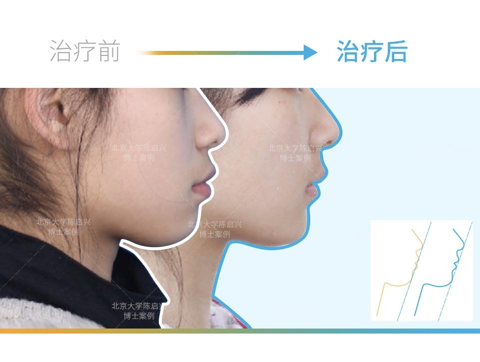 隐适美深覆合嘴突矫正案例