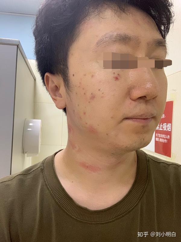 记录在空军总医院激光祛疣的过程