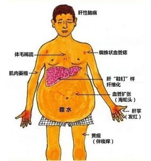 关于肝硬化的数据: 世界各国的年发病率在(25-400)/10万,病人以青