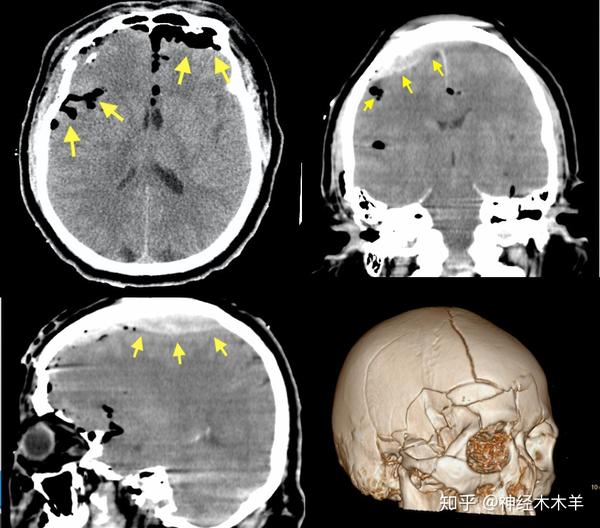 头颅ct提示:多发的颅骨骨折,右侧硬膜外血肿,颅内广泛积气.