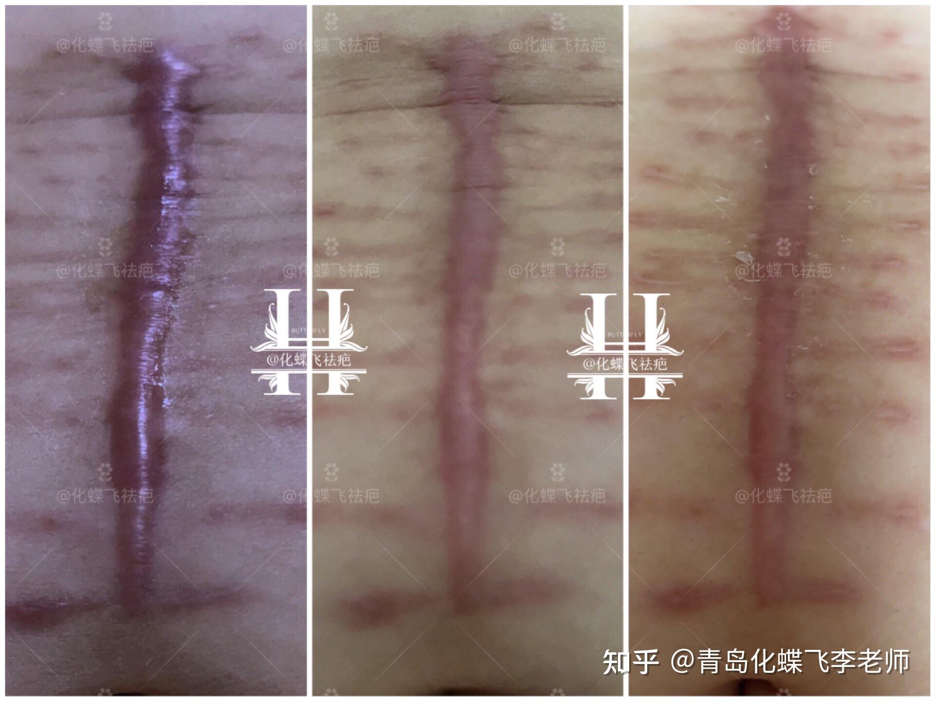 剖腹产增生疤痕修复