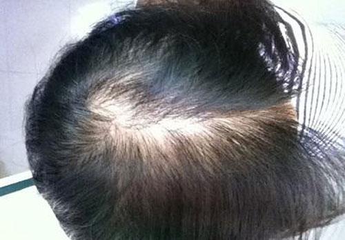 脂溢性皮炎导致的头发稀疏还有救吗?
