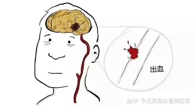 北京脑血管病医院神经内科专家教你正确识别脑卒中