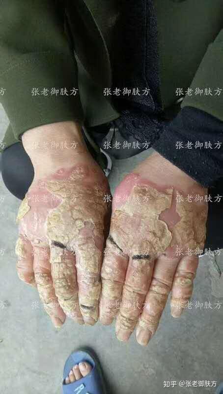新乡牛皮藓赵女士,先前只疗无数,钱花了不少,依然不见其效,经朋友推荐