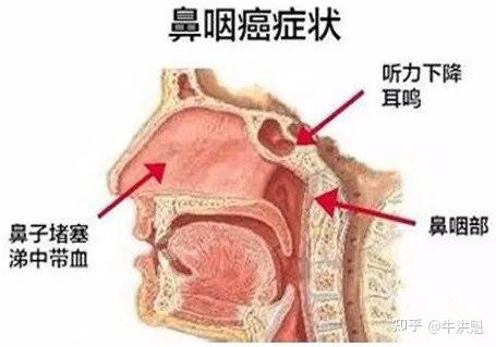 复发鼻咽癌的治疗进展