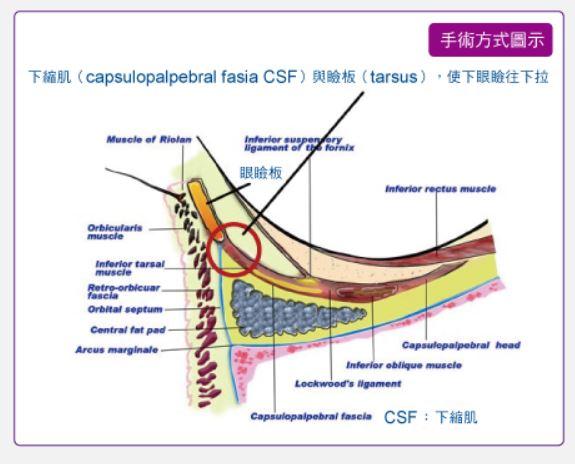 外眦比内眦高的挑眼,下睑过高的眼睛做,原理就是将下睑缩肌与睑板缝合