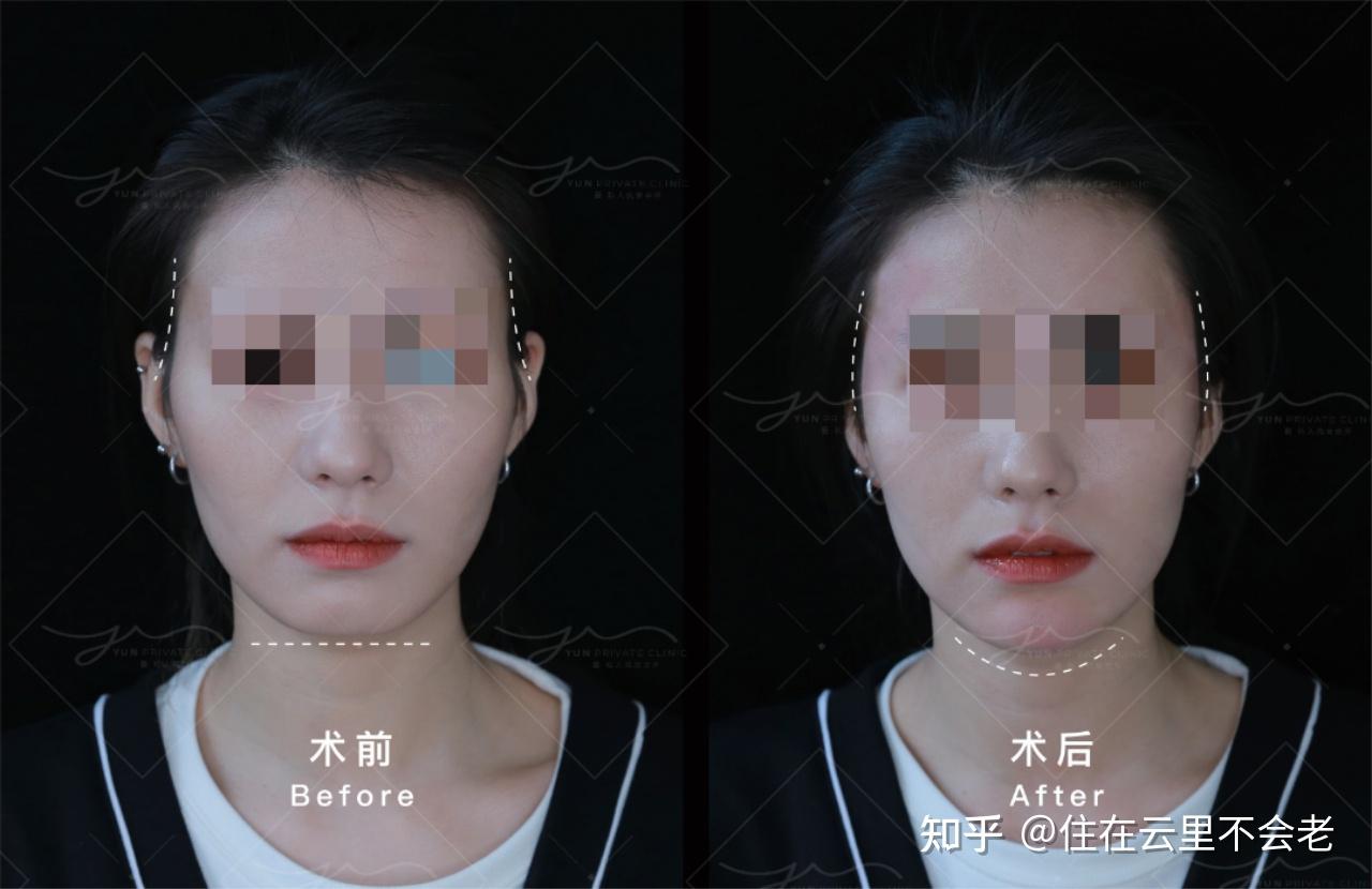 颧骨高太阳穴凹不做手术照样能脸型逆袭