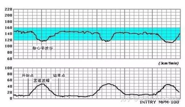 上会有两条曲线,一条记录的是胎心率的变化,另外一条记录的是宫缩情况